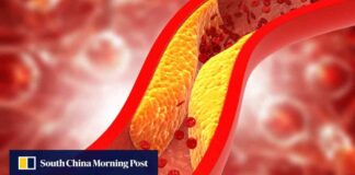 chinese-vaccine-effectively-reduces-artery-plaque-build-up