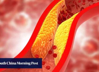 chinese-vaccine-effectively-reduces-artery-plaque-build-up