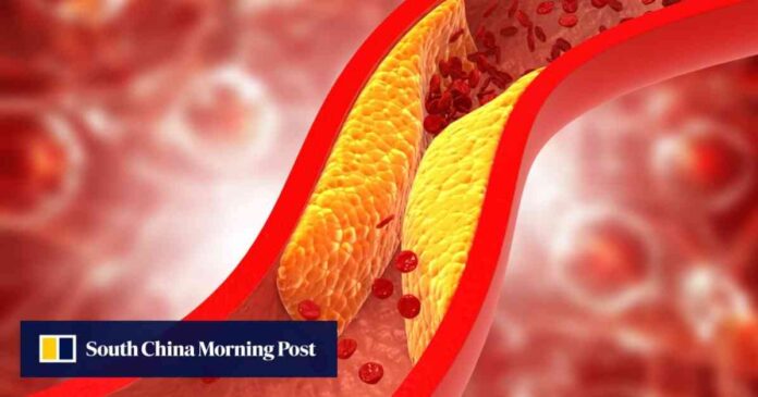 chinese-vaccine-effectively-reduces-artery-plaque-build-up